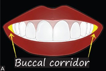 Buccal corridor at smiling