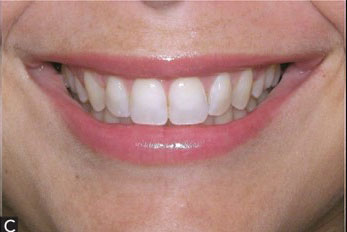 Intermediate buccal corridor