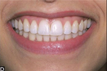 Narrow buccal corridor and a broad smile