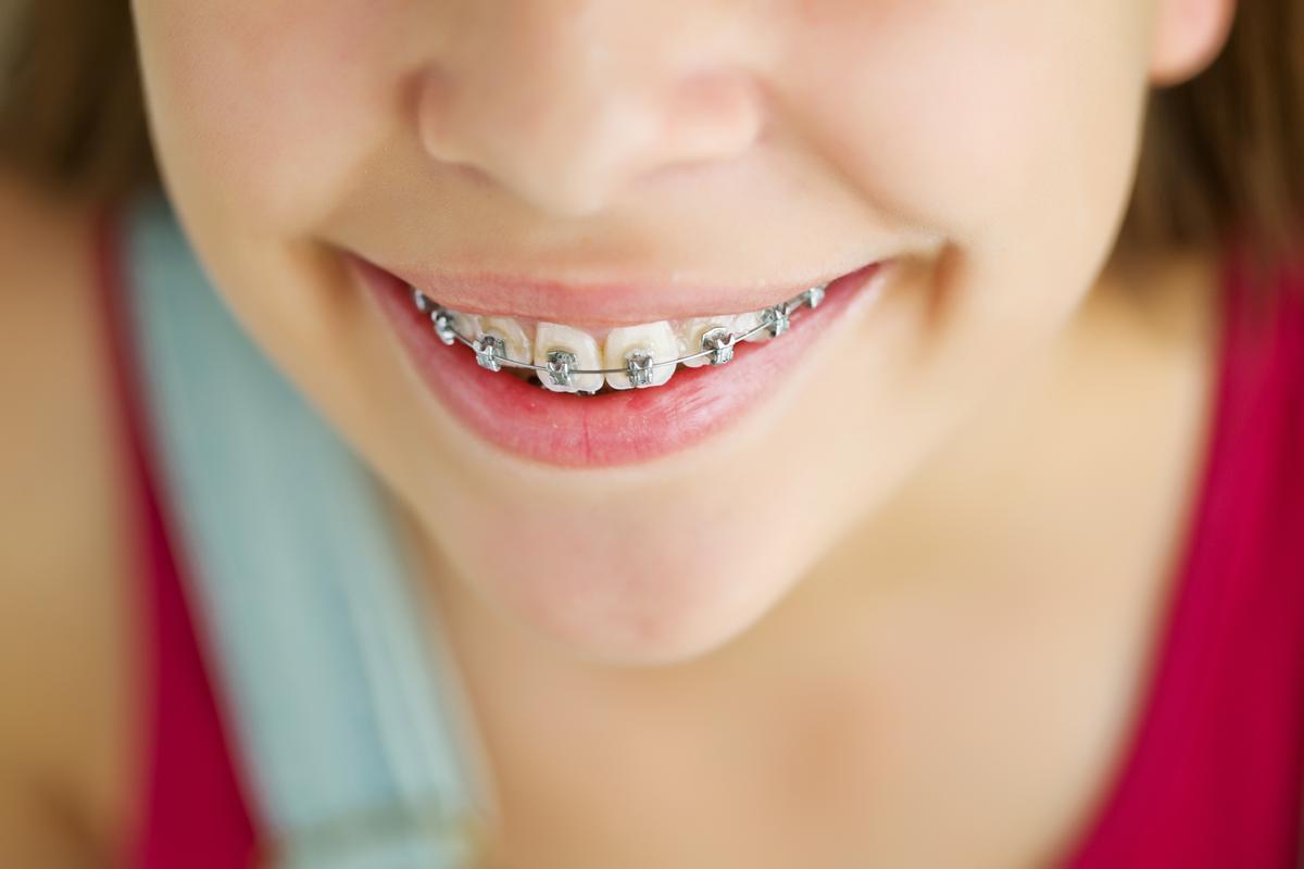 Best Braces for Kids