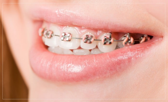 Dental Braces for Kids