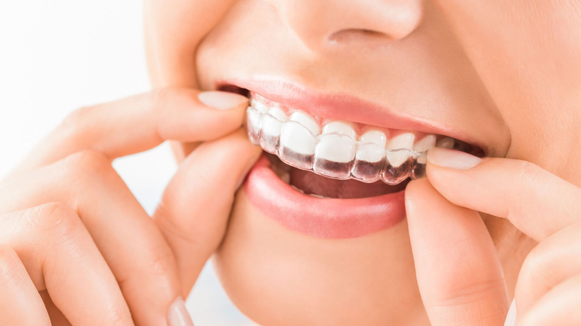 What Is Invisalign