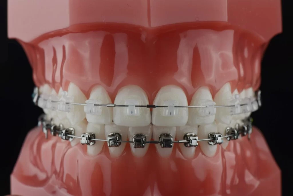 Everything You Need to Know About Self-Ligating Braces