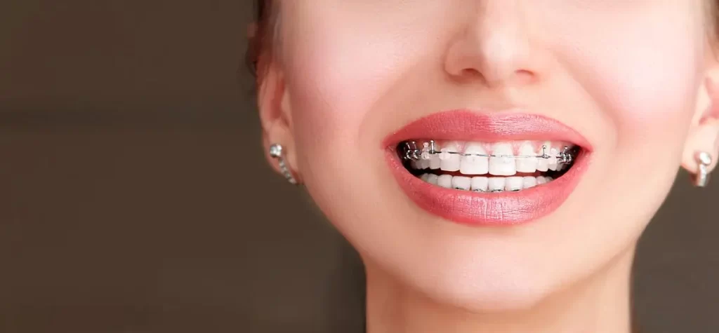 Benefits of Picking Invisalign Over Braces