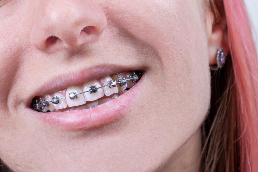 Are Self-Ligating Braces Faster?