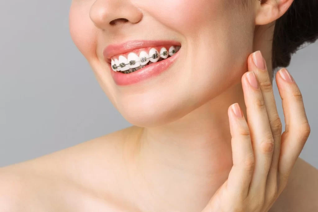 The Case for Traditional Braces