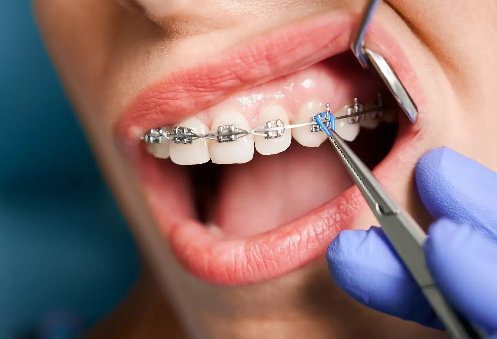 Orthodontic Emergencies: What to Do If Your Braces Break