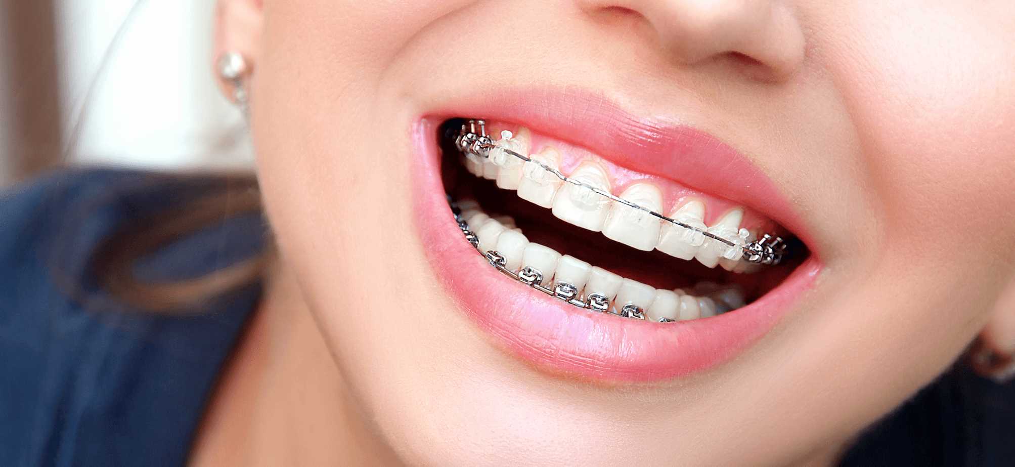 Why Choose an Orthodontist for Braces in Oakville: Top Benefits Explained