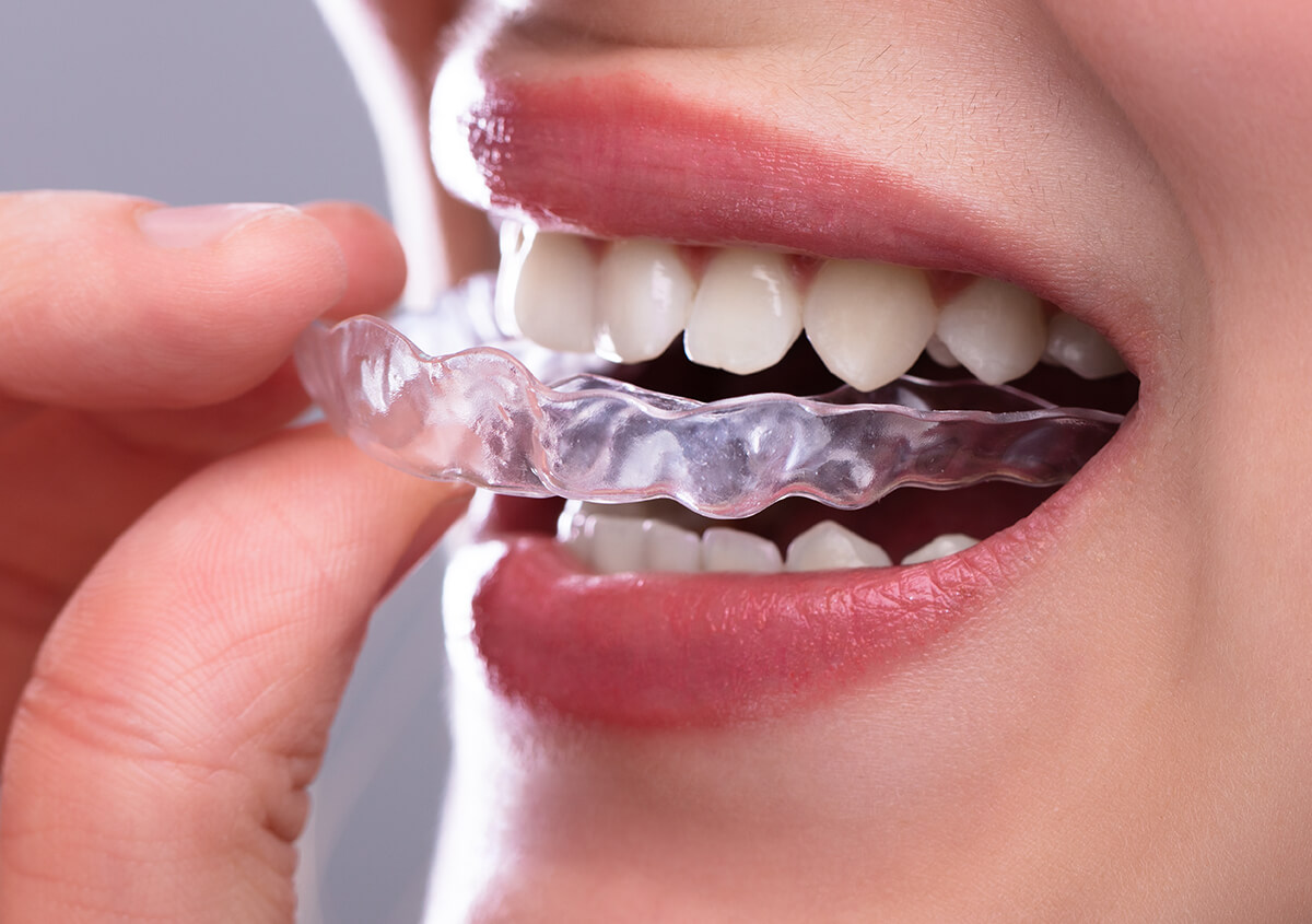 Is Invisalign the Best Choice for Straightening Teeth in Oakville?