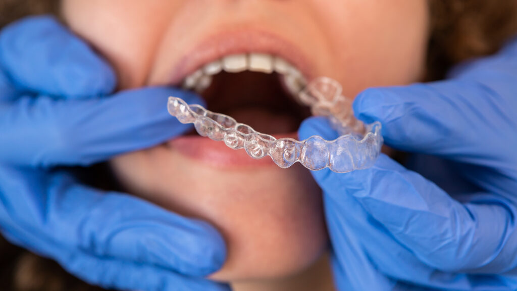 What Is the Difference Between Braces and Invisalign in Oakville?