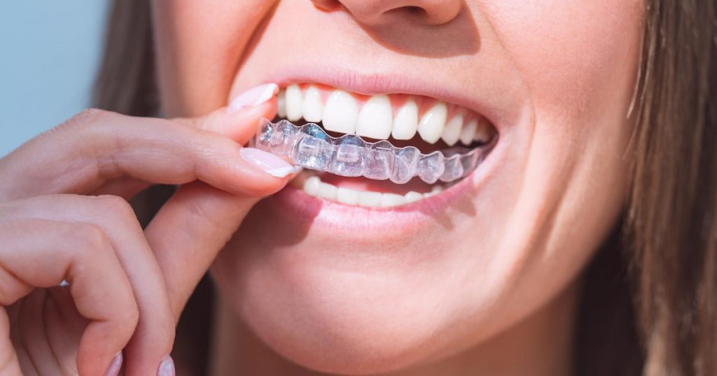 Benefits of Invisalign x