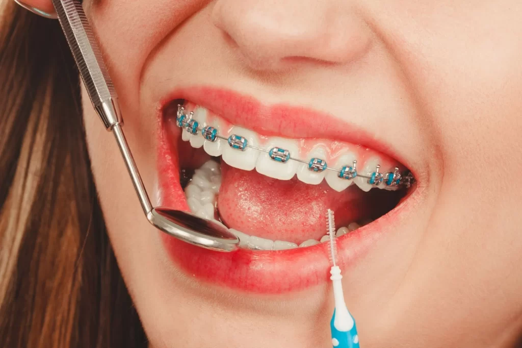 How Long Does Orthodontic Treatment with Braces Take in Oakville?