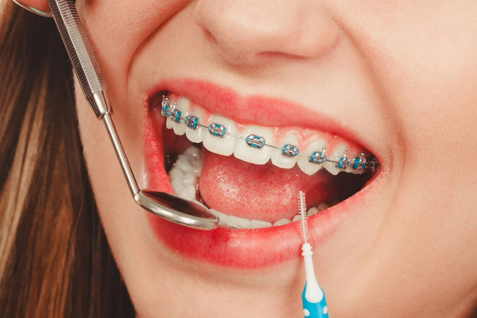 How Long Does Orthodontic Treatment with Braces Take in Oakville?