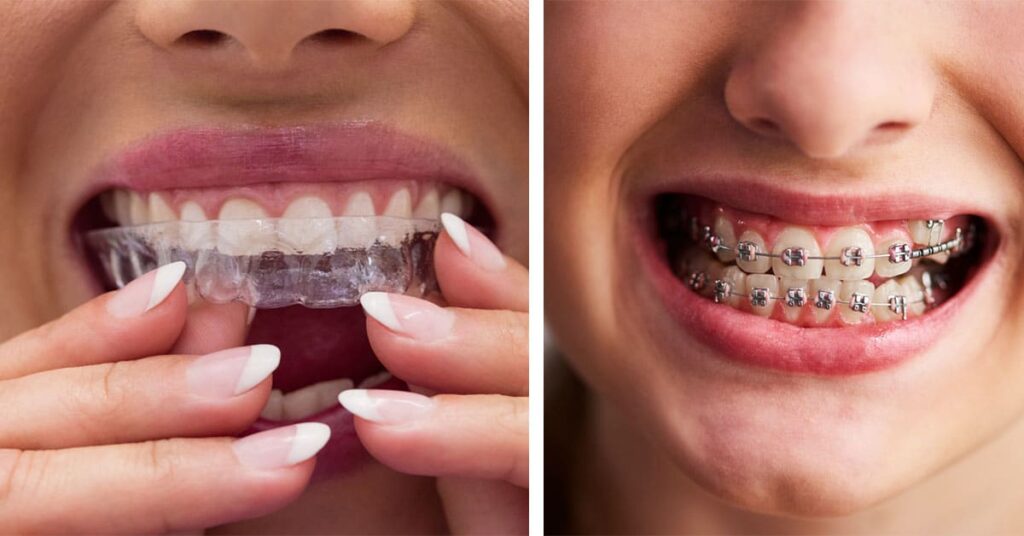 Why More Oakville Residents Are Choosing Braces for a Better Smile