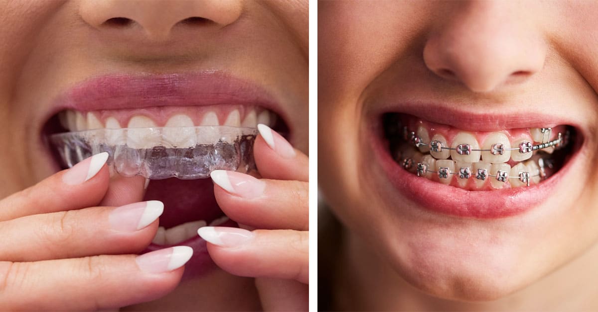 Why More Oakville Residents Are Choosing Braces for a Better Smile